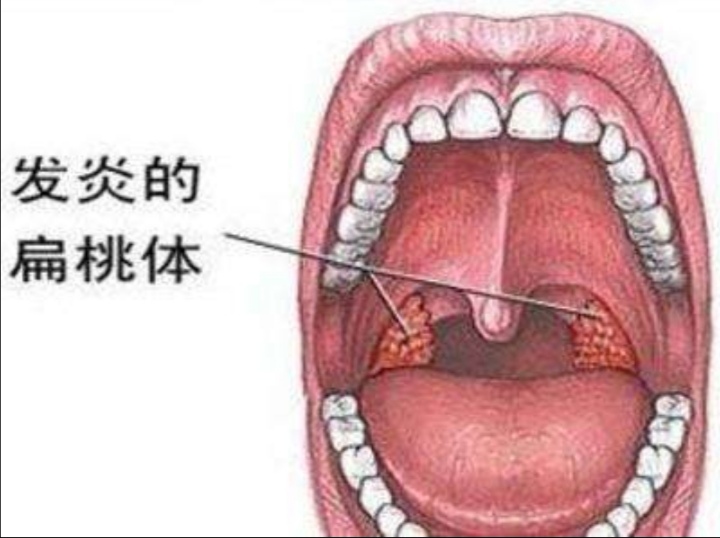 灼烙方法治疗慢性扁桃体炎